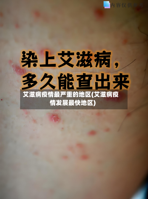 艾滋病疫情最严重的地区(艾滋病疫情发展最快地区)