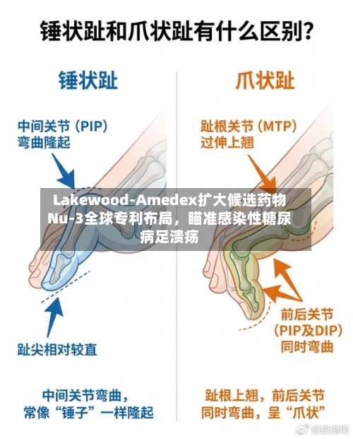 Lakewood-Amedex扩大候选药物Nu-3全球专利布局,瞄准感染性糖尿病足溃疡